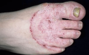 Les raisons de l'apparence du champignon sur les jambes