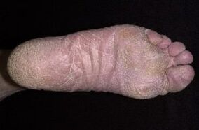 Signes et symptômes de champignon sur les jambes