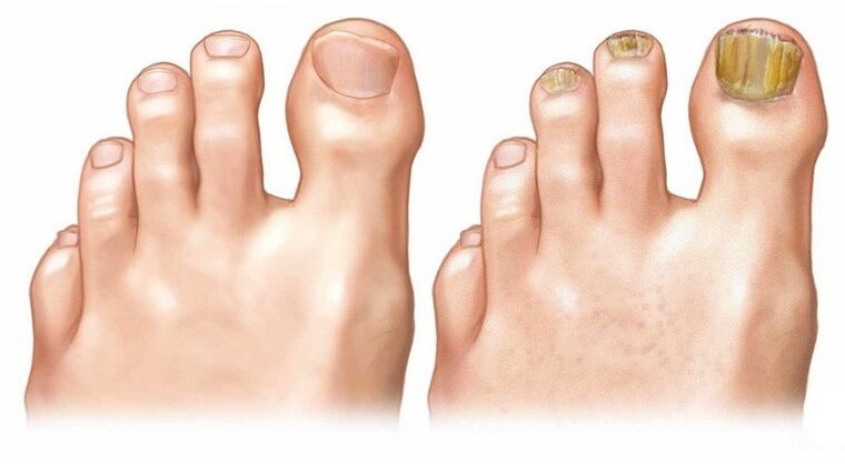 Ongles des ongles sains et infectés