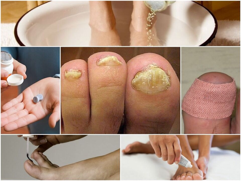 Traitement des champignons à ongles