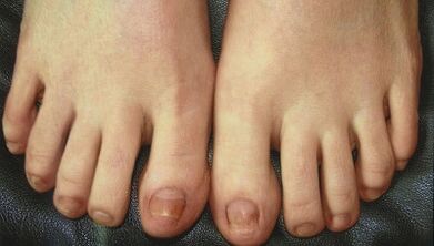 Étapes de développement des champignons à ongles