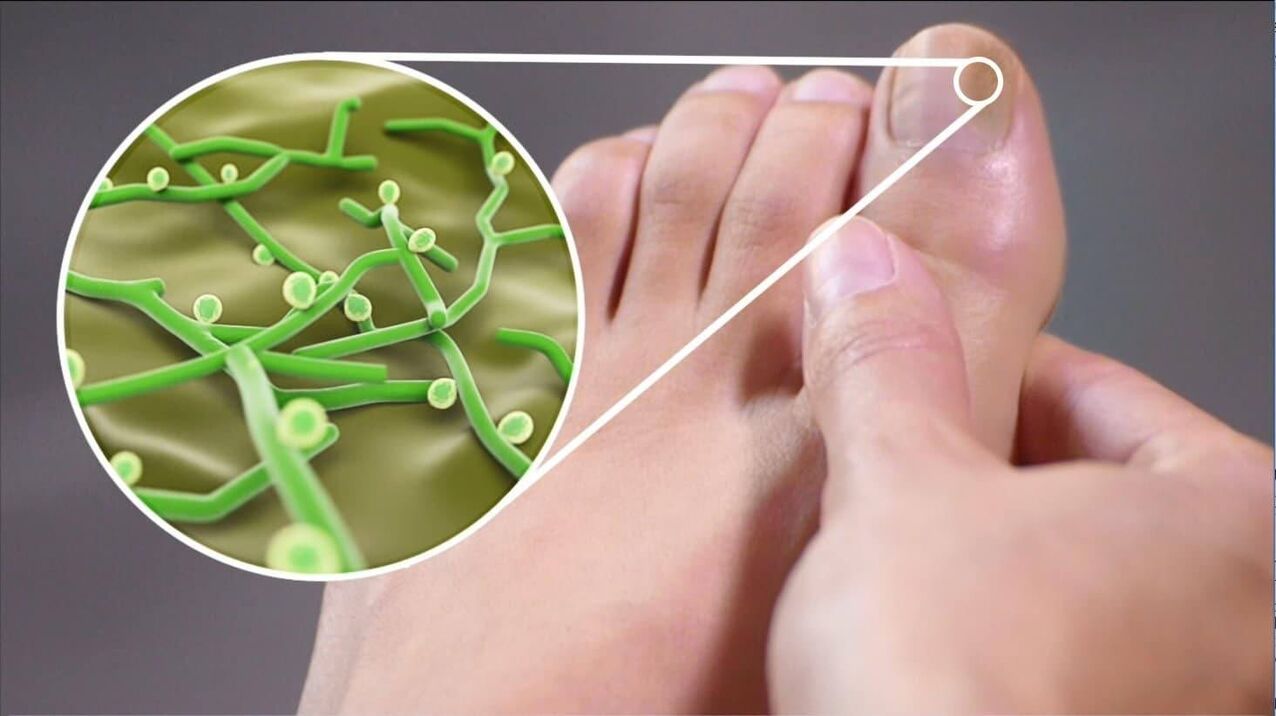 agents pathogènes du champignon des ongles des pieds