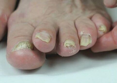 traitement de la mycose des ongles avec des médicaments