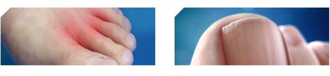 stade initial du champignon du pied